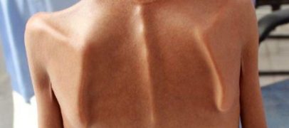 أطفال اليمن يتضورون جوعا وشبح المجاعة يلوح في الأفق من جديد